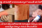 Gajji Tamara Treatment in Telugu Are you suffering from scabies and eczema