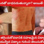 Gajji Tamara Treatment in Telugu Are you suffering from scabies and eczema