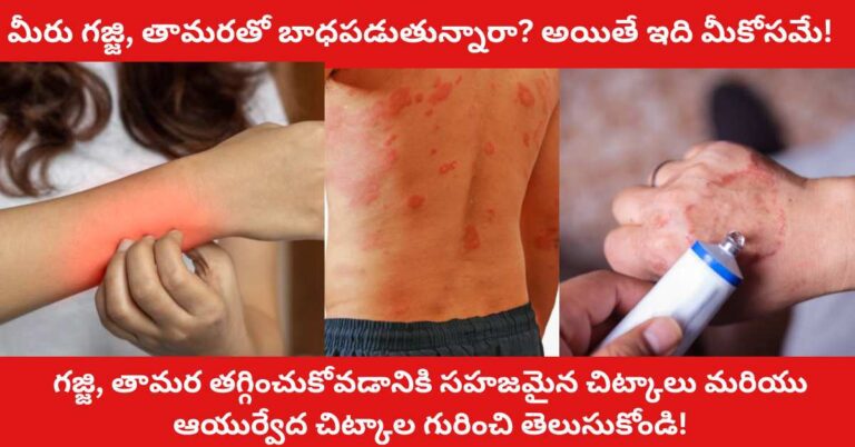 Gajji Tamara Treatment in Telugu Are you suffering from scabies and eczema